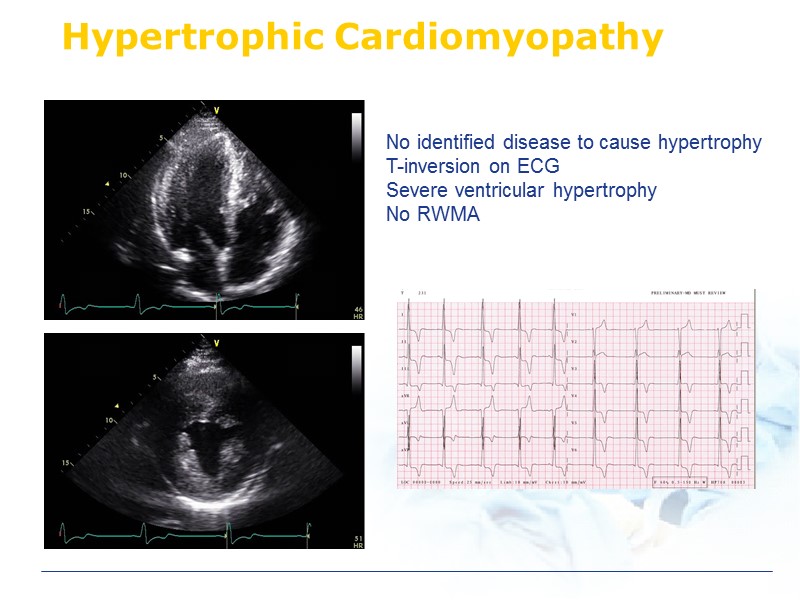 Hypertrophic Cardiomyopathy No identified disease to cause hypertrophy T-inversion on ECG Severe ventricular hypertrophy